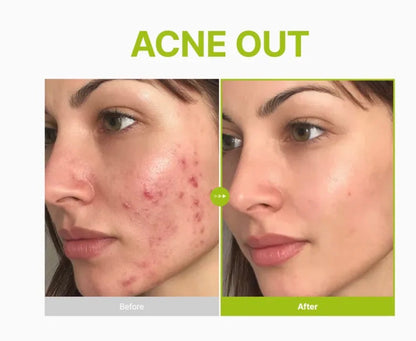 Purito SEOUL - Azelaic Acid 10 Kojic Tea Tree Serum